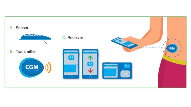 Continuous glucose monitoring product review