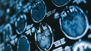 MRI of a brain