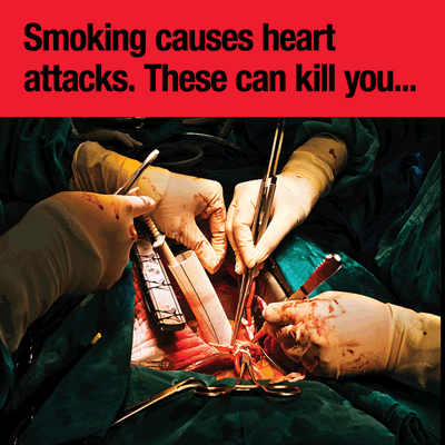 Smoking and heart attacks